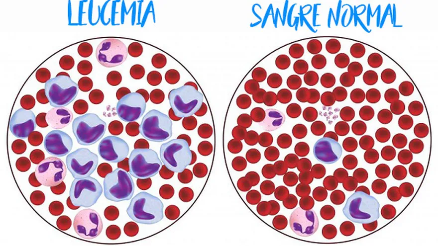 Tipos de leucemia