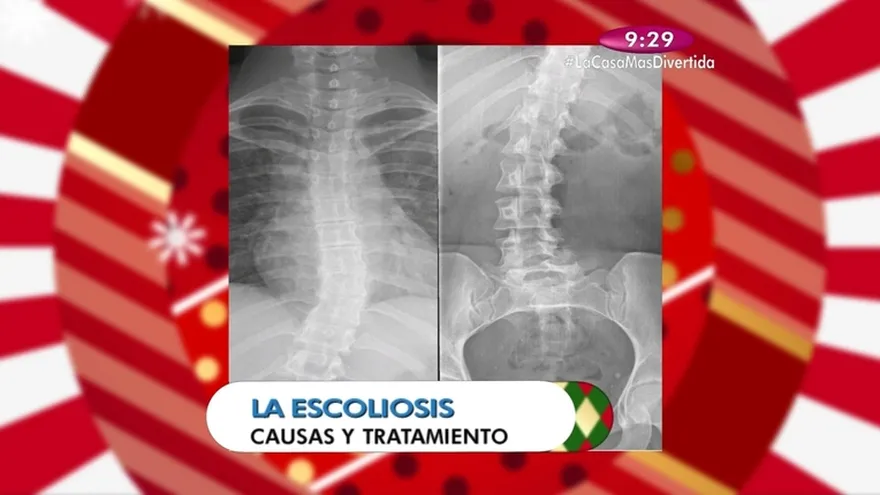Salud al día - La Escoliosis una enfermedad que afecta a gran número de panameños
