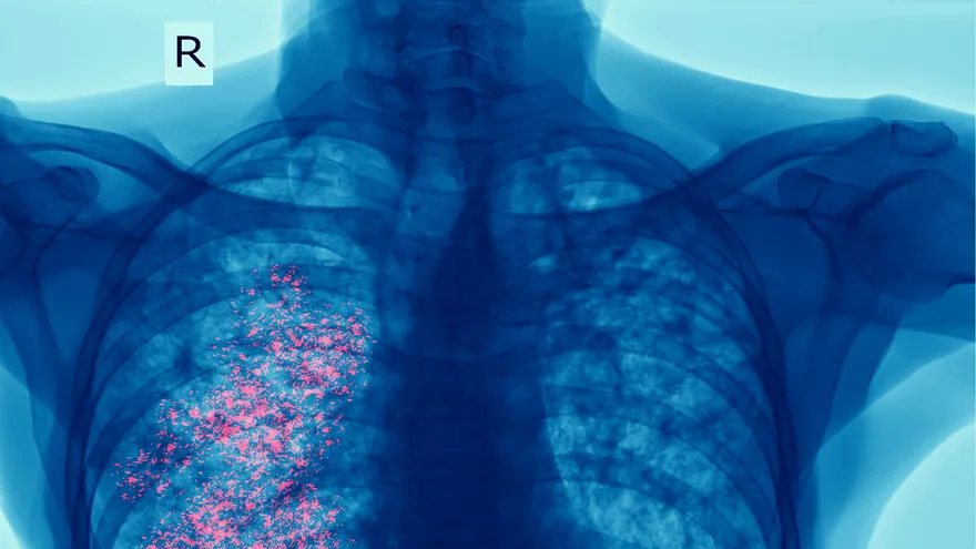 El cáncer de pulmón representa uno de los mayores desafíos para los sistemas de salud en el mundo