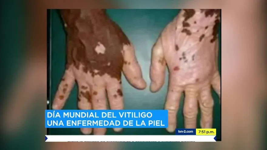 Panamá se une a la conmemoración del Día Mundial del Vitíligo