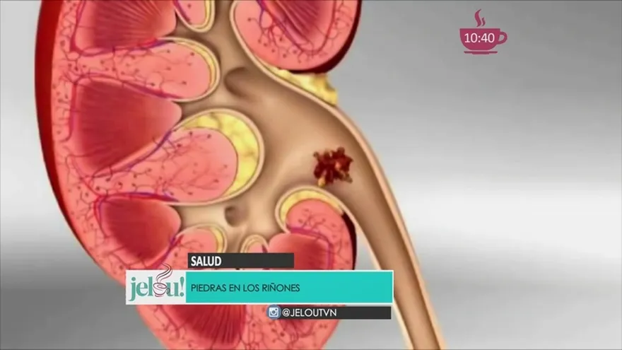Cálculos renales, cómo identificarlos.