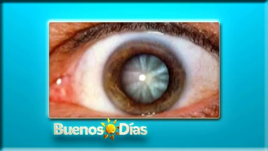 Salud al Día - Tienes visión borrosa o nublada, sientes sensibilidad a la luz? tal vez estás sufriendo de cataratas