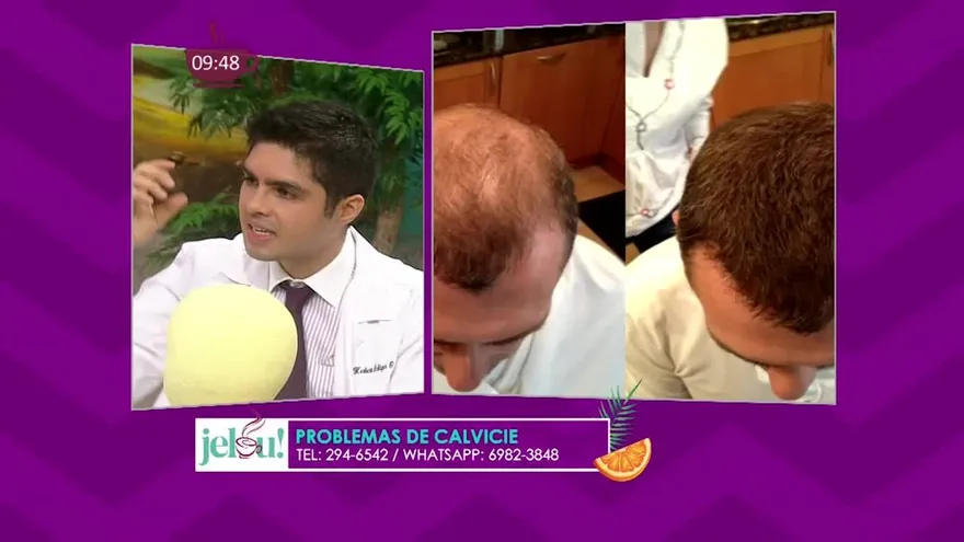 Problemas de calvicie