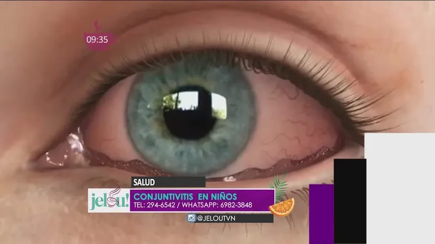 La conjuntivitis en niños es un muy común, cómo saber si es vírica, bacteriana o alérgica