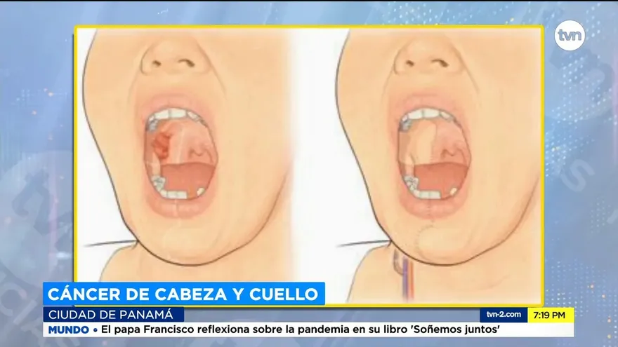 Factores de riesgo que podrían ocasionar cáncer de cabeza y cuello