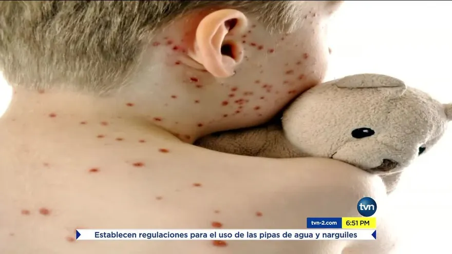 Piden vacunar a los niños contra el sarampión