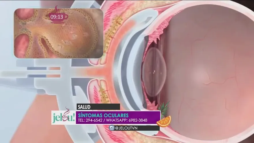 ¿Tienes dolor, ardor, o algún malestar en tus ojos? ¡Cuidado! Puede significar algo no tan bueno