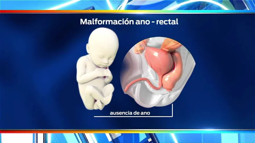 Niña de Coclesito aún espera por operación