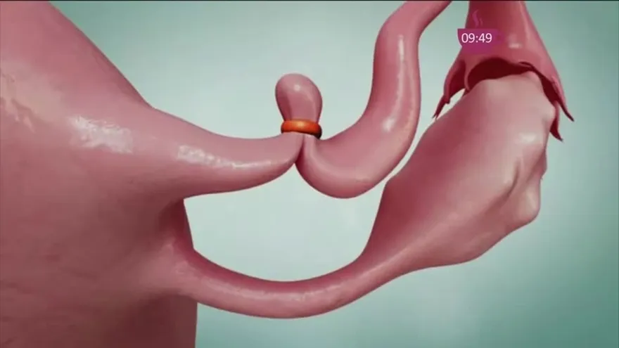 Ligadura de trompas de Falopio. Un método definitivo para no tener hijos.