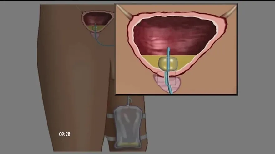 ¿Sientes que tu forma de orinar no es normal?