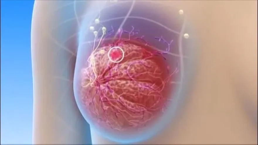 Un diagnóstico a tiempo de Cáncer de Mama puede salvar tu vida