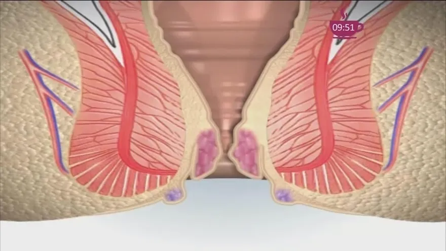 ¿Qué tan peligrosas son las  hemorroides? ¡Aquí te lo decimos!