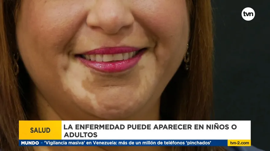 Vitiligo, enfermedad autoinmune que afecta al 1% de la población