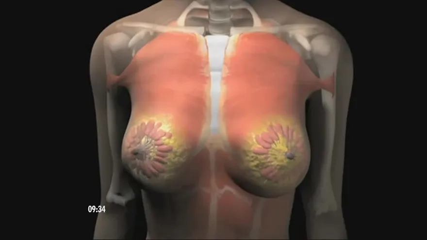 Cuáles son las expectativas de vida de una mujer con cáncer de mama según el diagnóstico