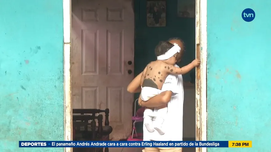 Angélica padece una rara enfermedad en la piel y necesita tu ayuda