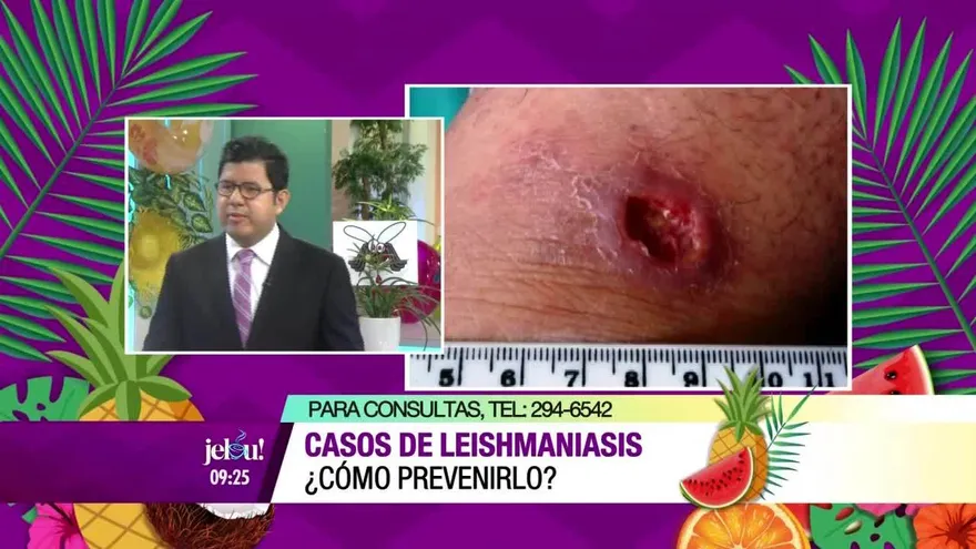 Casos de leishmaniasis ¿Cómo prevenirlo?