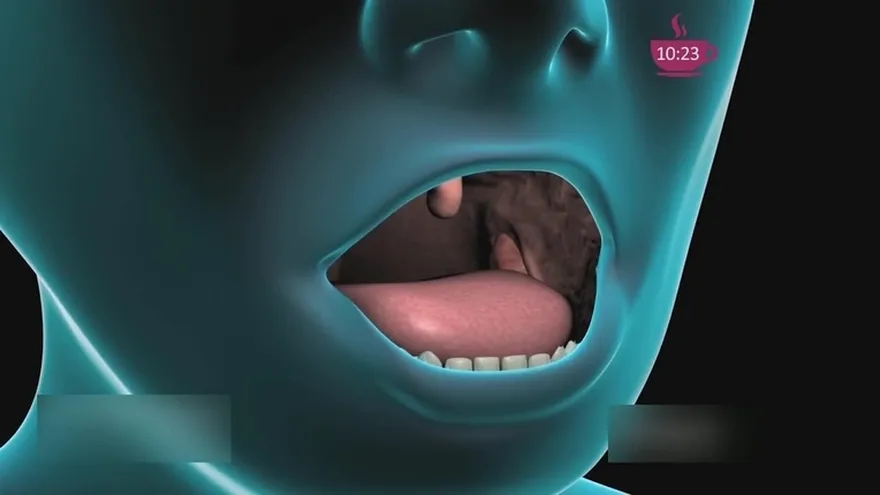 ¿Siempre estás resfriado?, ¡cuidado!, podría ser Amigdalitis