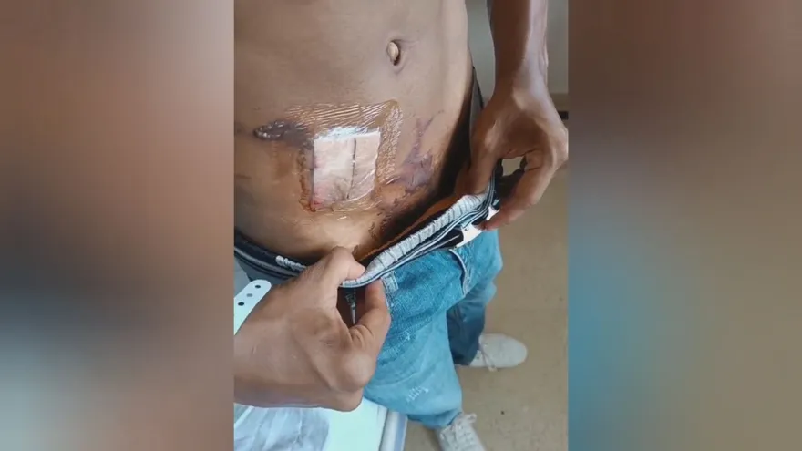 Padre denuncia negligencia médica tras quemaduras a joven durante cirugía en La Chorrera