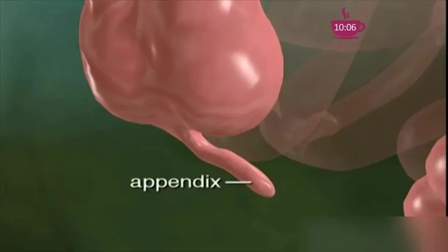 ¿Sospechas que puede ser apendicitis?