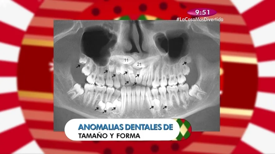 Salud Dental - Anomalía dentales e