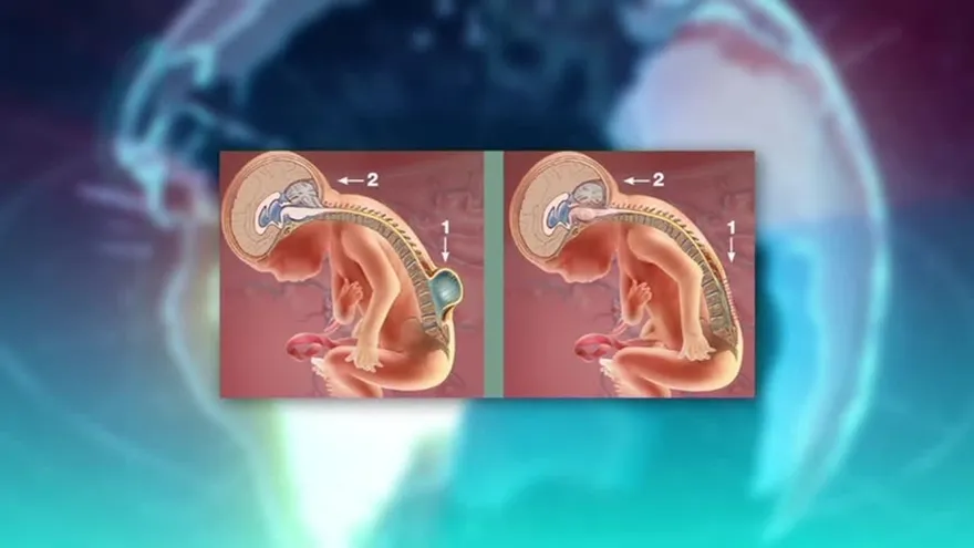 ¿Qué es la espina bífida?