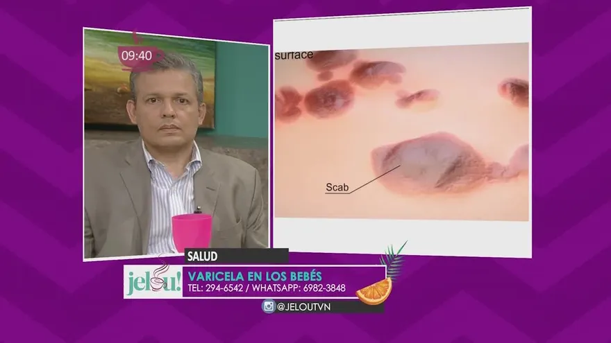 Varicela en bebés, conoce cómo evitar efectos secundarios