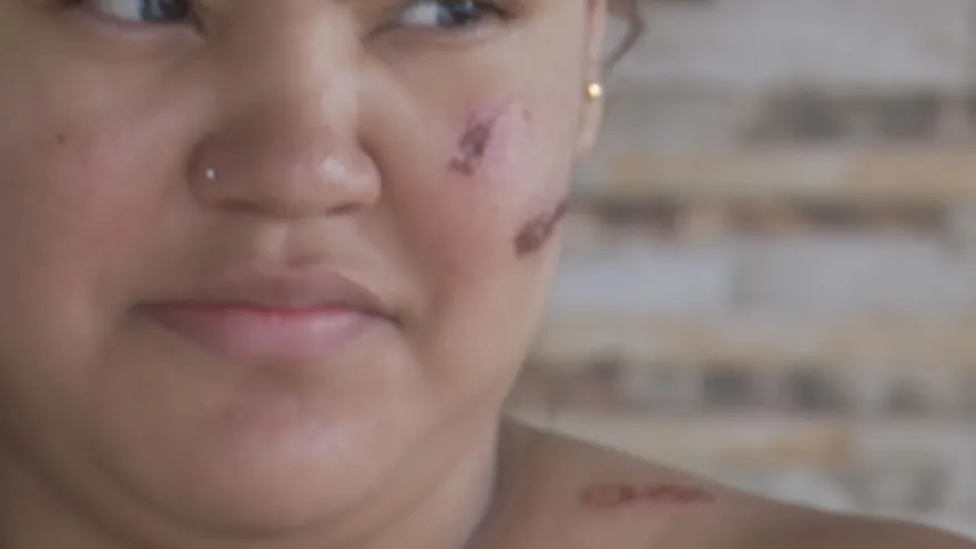 Uso de perdigones por policías deja civiles heridos en Las Cinco Vías