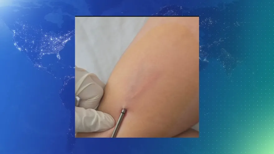 ¿Qué es el implante subdérmico?