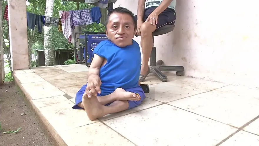 Cumplirán los sueños de Adaín, ‘el hombre de cristal’