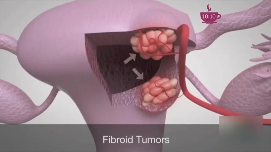 ¿Cómo saber que tienes problemas de fibromas?