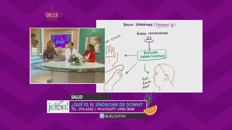 ¿Qué es el Síndrome de Down?