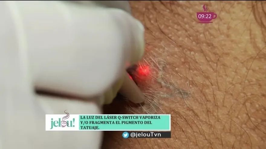 Tratamiento para quitar tatuajes sin dañar la piel
