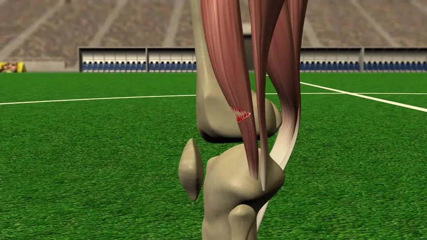 Videografía: Lesiones isquiotibiales