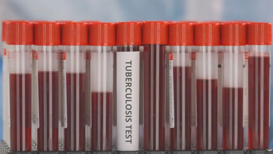 Test de tuberculosis. Imagen ilustrativa