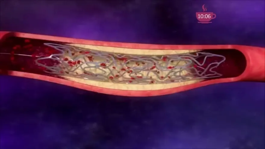 ¿Qué es el síndrome antifosfolípido? Conoce sobre este estado y sus métodos terapéuticos