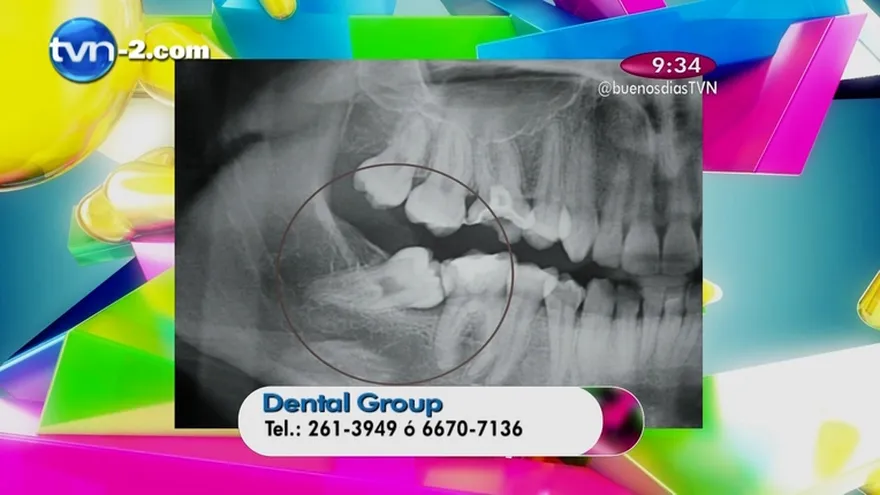 Segmento Salud Dental - Problemas de salud Dental asociadas con la Muela del Juicio