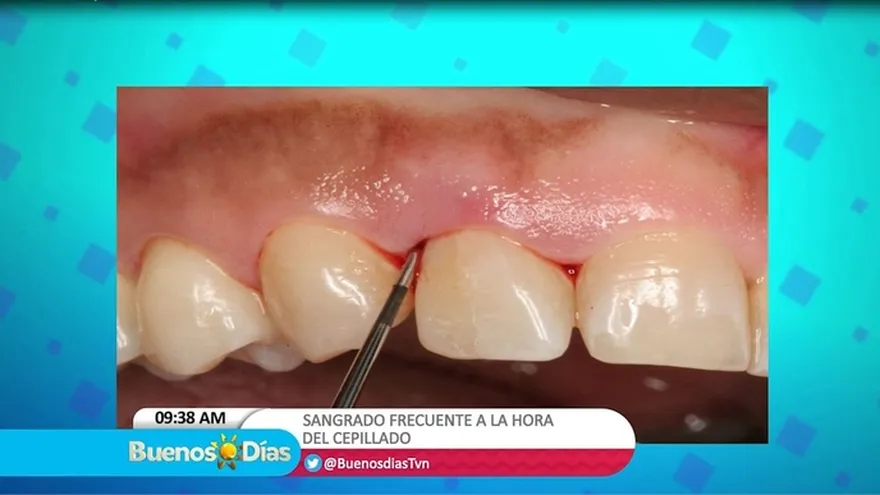 Sangrado frecuente a la hora de cepillarte