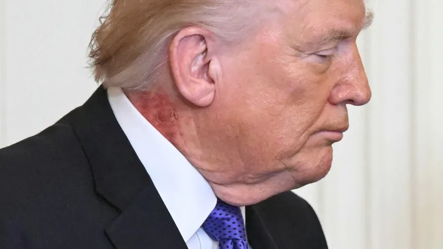 Donald Trump tiene una mancha en el cuello.