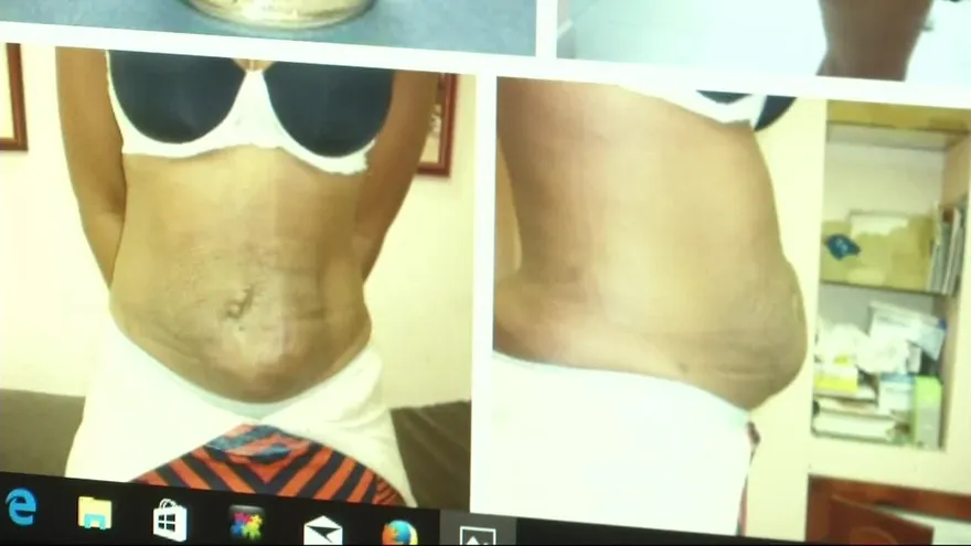 Aumentan casos de cirugías estéticas con complicaciones en Panamá