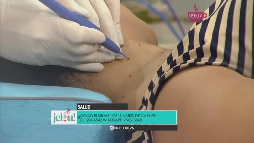Lunares de Carne: Tratamientos y Consideraciones