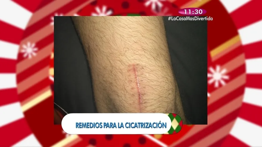 Yerbatero - Remedio para la Cicatrización