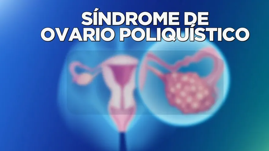 ¿Qué es el síndrome de ovario poliquístico?