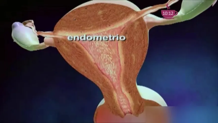 Tienes mucho sangrado, puedes sufrir de Endometriosis