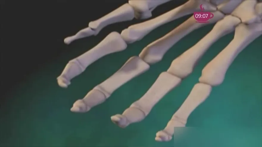 Me diagnosticaron Artritis. "Sufro de dolores constantes en las manos"