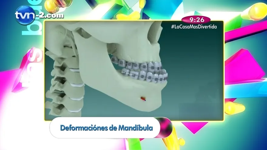 Salud Dental - Deformaciones del la Mandíbula