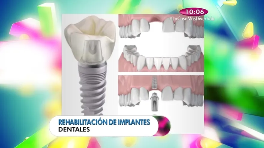 Salud Dental - Rehabititación de implantes dentales