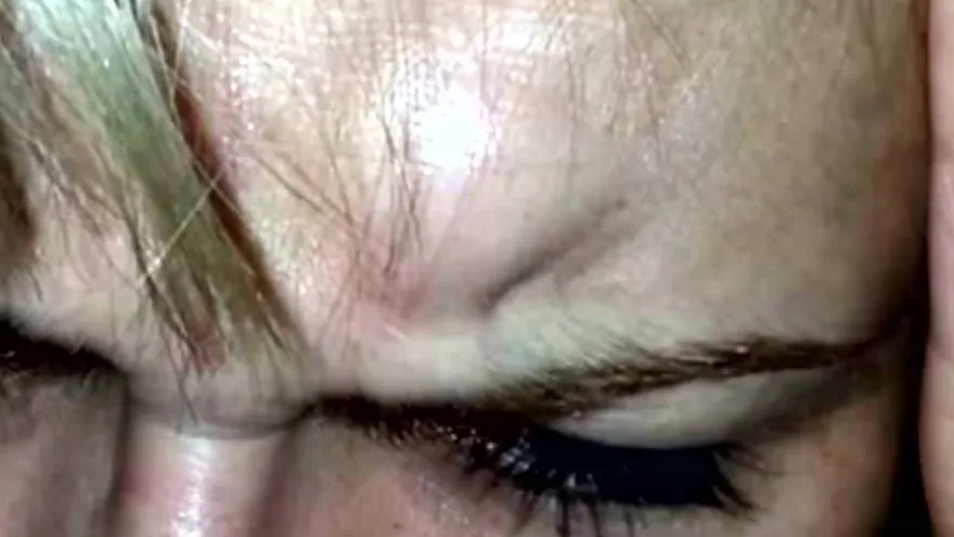 El peligro de los rellenos para las arrugas