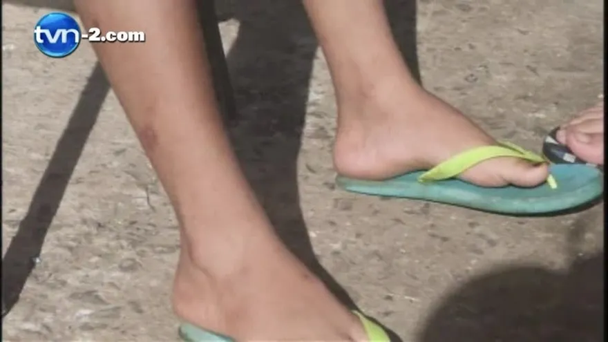 Aumentan los casos de Leishmaniasis en Panama Oeste