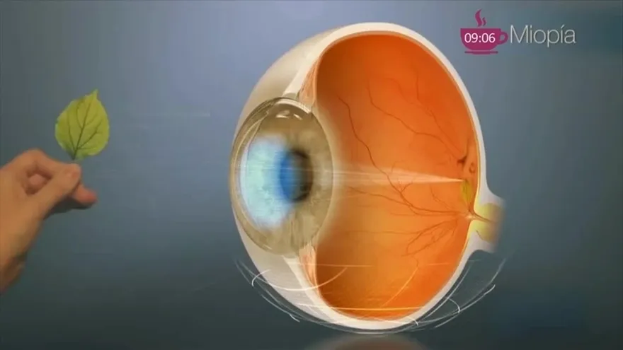 Los errores refractivos en la visión ¿Qué son estos errores?