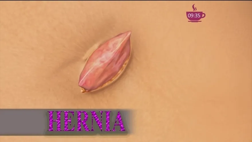 ¿Puede resultar muy peligrosas las  Hernias?